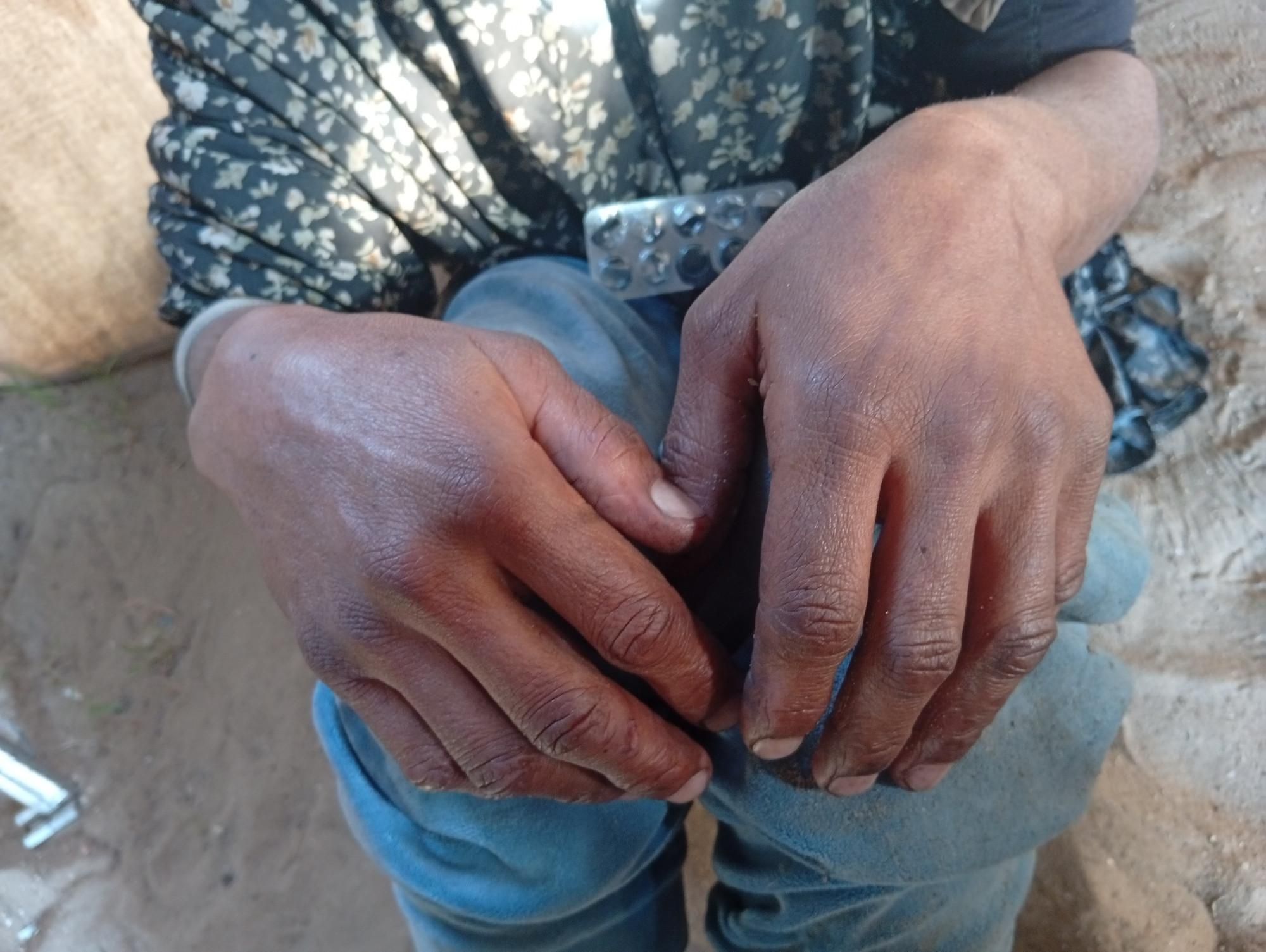 Faten's hands are swollen because of the disease