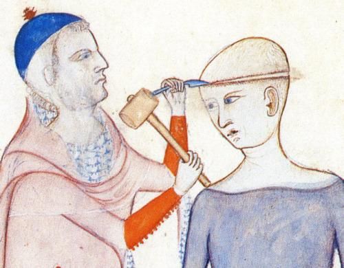 Medieval illustration of doctor opening someone's skull