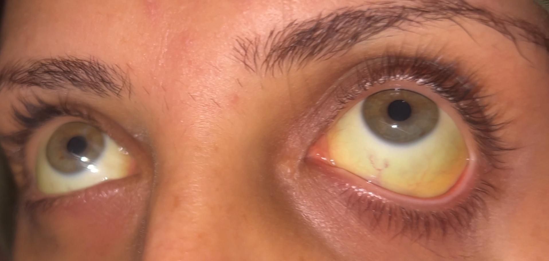 Viral hepatitis is exhausting my pregnant wife:
yellowing of the eyes, severe fatigue, diarrhea, and loss of appetite, due to pollution in Gaza.

She is not carrying the illness alone—she is carrying an innocent unborn child.
We are asking for a basic right: medical care, safe food and water, and a life with dignity.

Please help by offering support or by sharing our voice.
Silence kills slowly. Gaza is suffocating.
https://gofund.me/55f61573